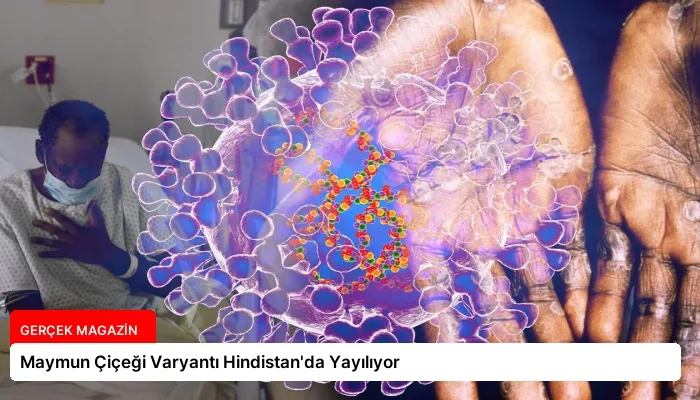 Maymun Çiçeği Varyantı Hindistan’da Yayılıyor