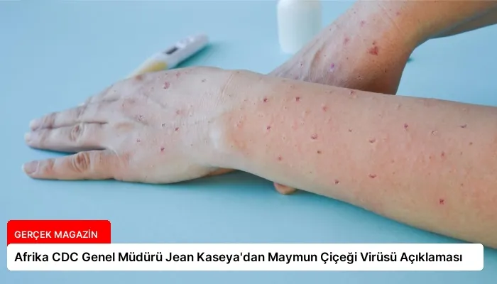 Afrika CDC Genel Müdürü Jean Kaseya’dan Maymun Çiçeği Virüsü Açıklaması